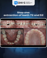 Missing Maxillary Lateral Incisors: Space Closure in All Malocclusions vs. Implants and Prosthetic Replacement