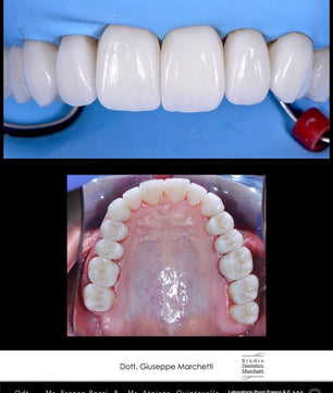 Ceramic Restorations:  Veneers, Inlays, Crowns - Dental Courses | كورسات طب اسنان
