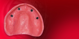 Implant‑Retained Dentures: Innovative Approaches to Full‑Arch Prosthetics