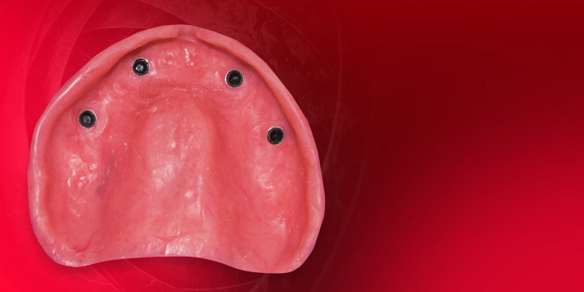 Implant‑Retained Dentures: Innovative Approaches to Full‑Arch Prosthetics-course
