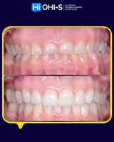 Tooth Wear Management: Italian School Protocols