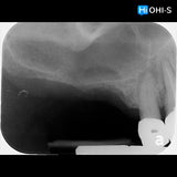 Predictable Sinus Lift