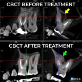 Apical Surgery: For Endodontists and Surgeons