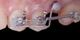 Orthodontic Preparation Before Prosthetics
