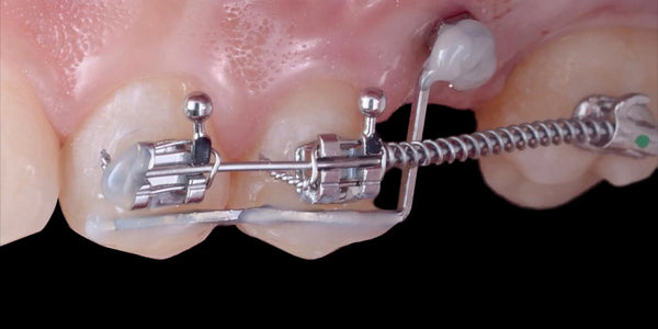 Orthodontic Preparation Before Prosthetics