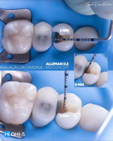 Indirect Restoration in the Biomimetic Concept
