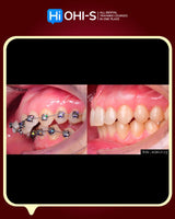 Damon 2.0. How to treat all common malocclusions