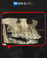 Apical Surgery: For Endodontists and Surgeons