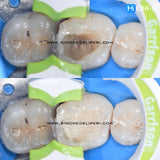 Indirect Restoration in the Biomimetic Concept