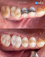The Biomimetic Concept: Composite Restoration Protocols