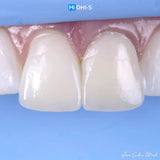 The Biomimetic Concept: Composite Restoration Protocols