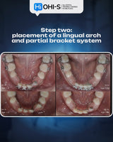 Missing Maxillary Lateral Incisors: Space Closure in All Malocclusions vs. Implants and Prosthetic Replacement