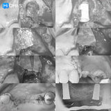 Soft Tissue Plastic Surgery around Implants