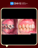 Damon 2.0. How to treat all common malocclusions