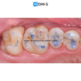 The Biomimetic Concept: Composite Restoration Protocols