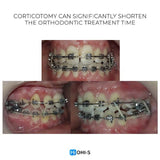 Accelerated Orthodontics: Baruti‑Demiraqi Corticotomy Protocol