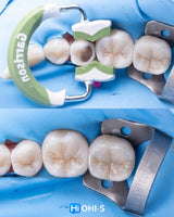 The Biomimetic Concept: Composite Restoration Protocols
