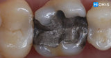 International Schools Working with Composite Restorations