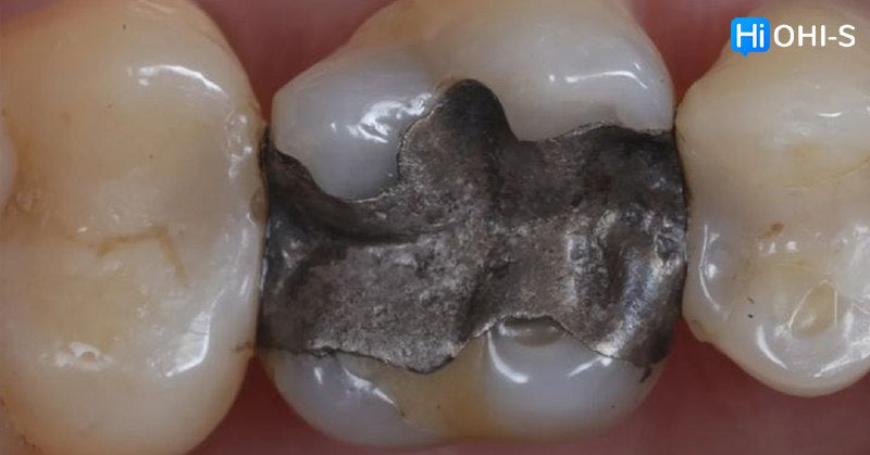 International Schools Working with Composite Restorations