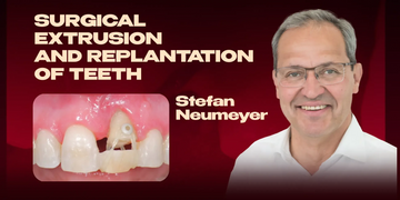 Surgical extrusion and replantation of teeth