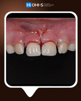 Dental Trauma Without Drama