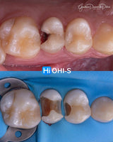 The Biomimetic Concept: Composite Restoration Protocols