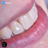 Composite Veneers, All Restorative Techniques