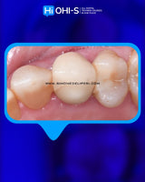 The Biomimetic Concept: Composite Restoration Protocols