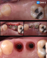 Soft Tissue Plastic Surgery around Implants