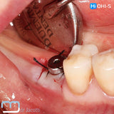 Predictable Sinus Lift
