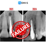 Apical Surgery: For Endodontists and Surgeons