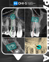 What’s NEW in Endodontics: From Anesthesia to Obturation