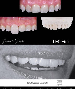Ceramic Restorations:  Veneers, Inlays, Crowns - Dental Courses | كورسات طب اسنان
