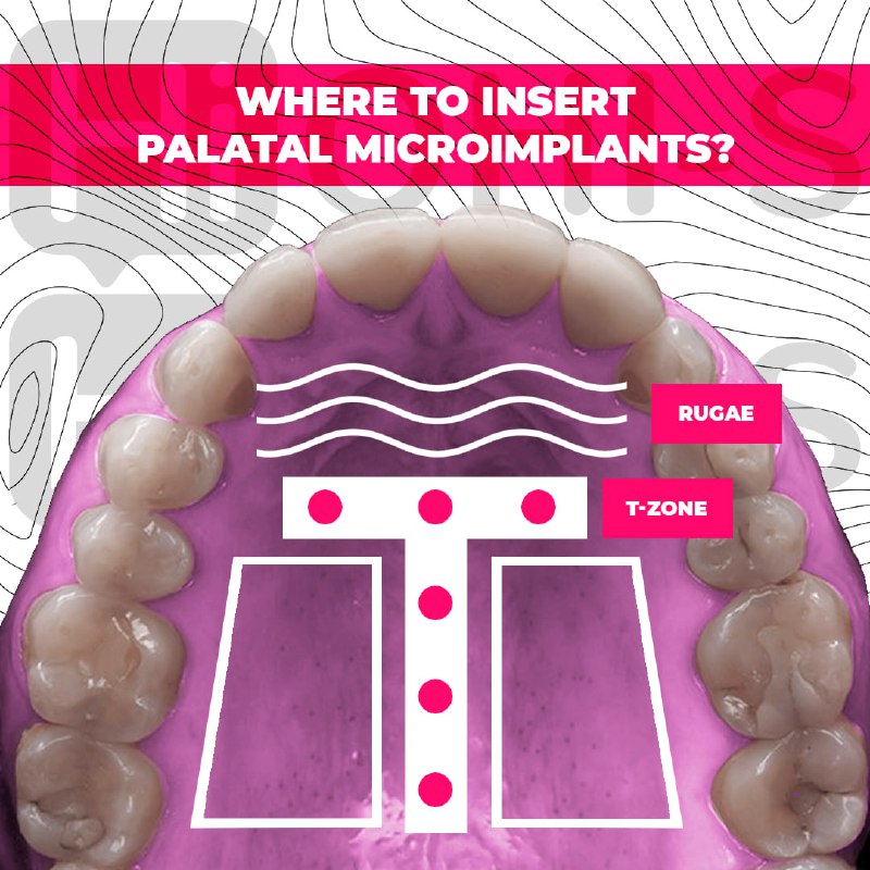 Challenging orthodontic cases: the use of skeletal anchorage
