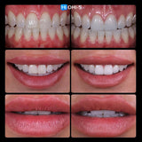 Anterior Veneers: Digital Manufacturing Protocols for Functional and Aesthetic Restorations