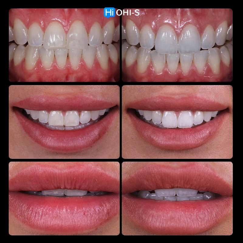 Anterior Veneers: Digital Manufacturing Protocols for Functional and Aesthetic Restorations