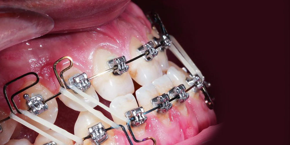 Signs indicating for orthodontic treatment