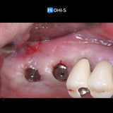 Predictable Sinus Lift