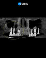 Predictable Sinus Lift