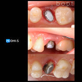 Saving Hopeless Teeth: Surgical and Conservative Protocols