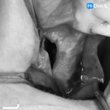 Predictable Sinus Lift
