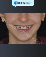 Early Orthodontic Treatment: When and How?