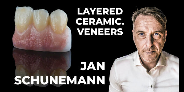 Layered ceramic. Veneers