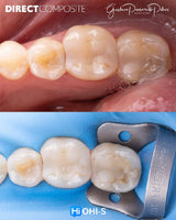 The Biomimetic Concept: Composite Restoration Protocols