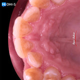 Damon 2.0. How to treat all common malocclusions