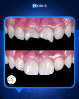 Anterior Aesthetics: The Complete Composite Guide