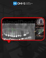 Apical Surgery: For Endodontists and Surgeons