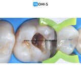 The Biomimetic Concept: Composite Restoration Protocols