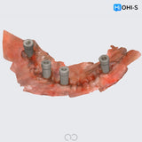 All‑Digital Workflow: Protocols for Flawless Indirect Restorations