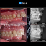 Aligners and Microimplants: Combined Protocol
